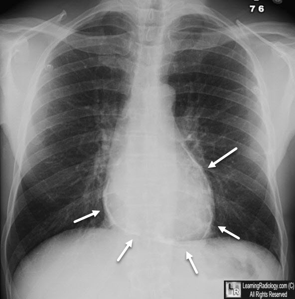 Constrictive Pericarditis